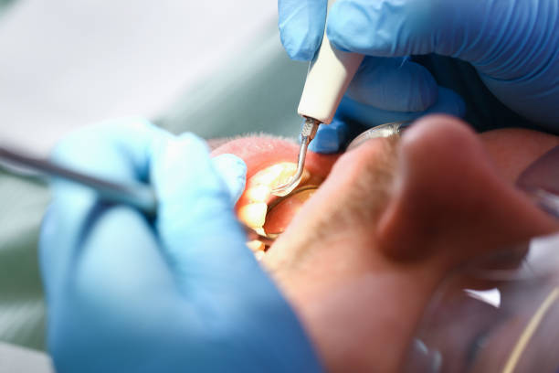 Best Emergency Dental Extractions in Hudson, FL