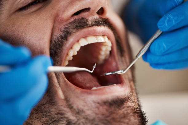 Best Emergency Dentist for Lost Fillings or Crowns in Hudson, FL